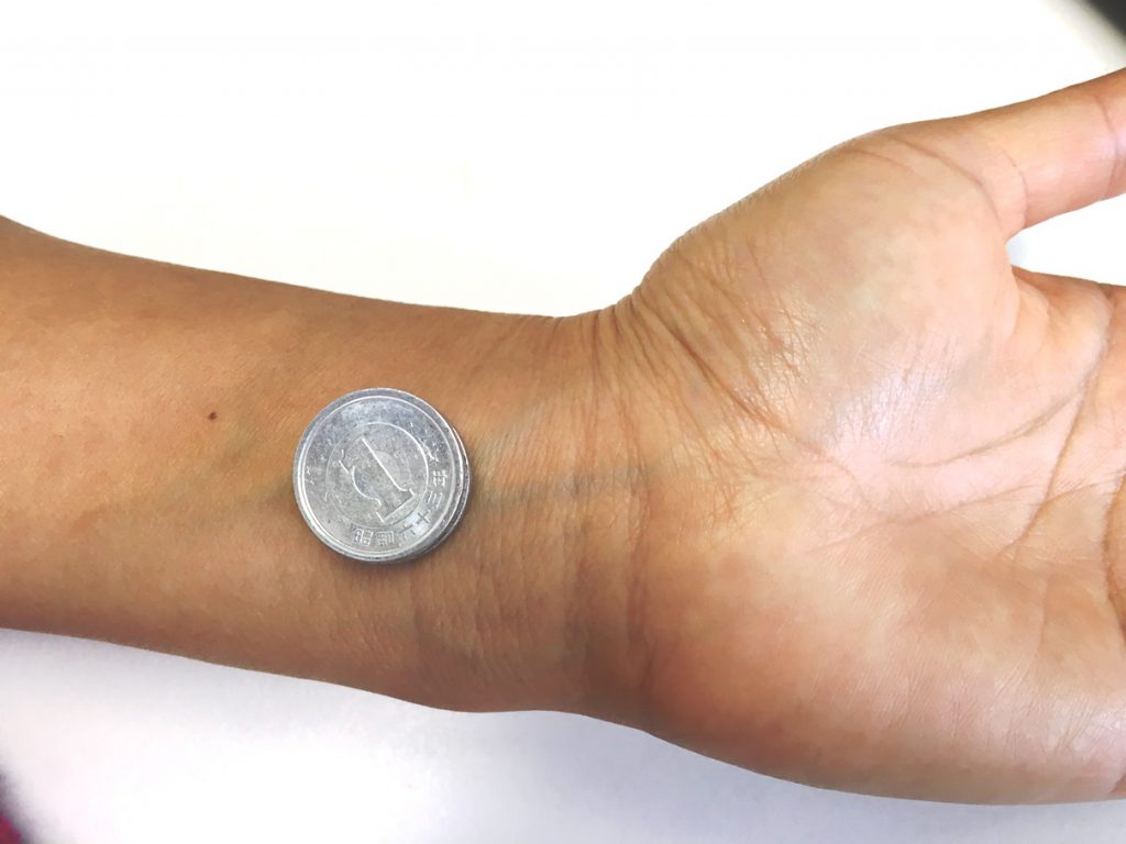 内関のツボに4円(よえん)